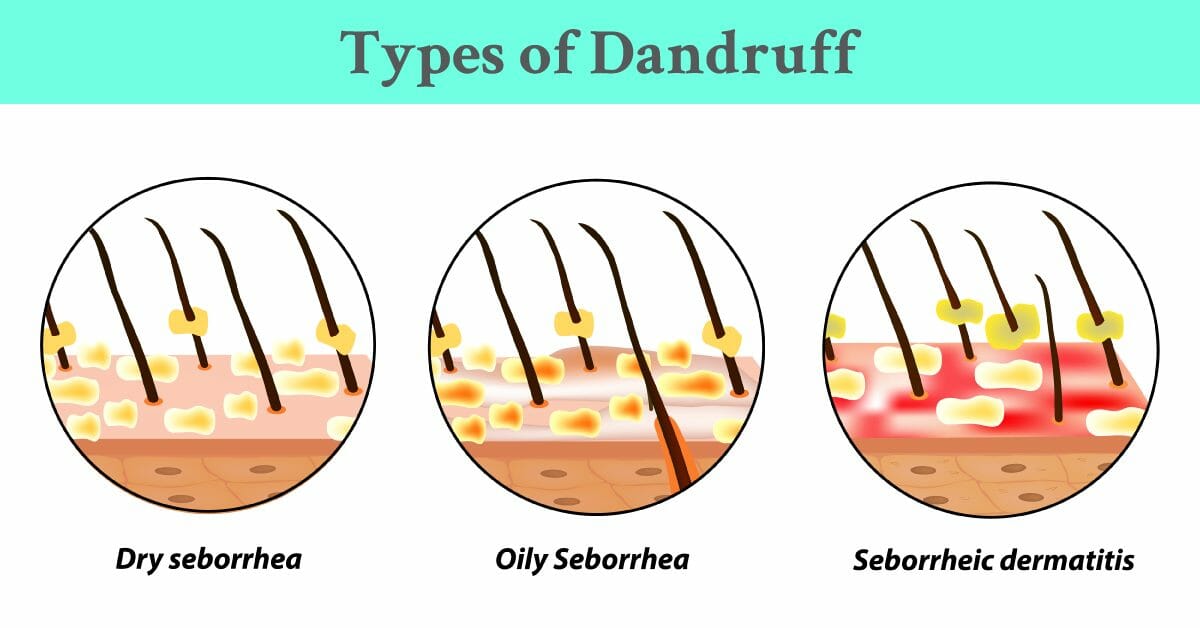 A Comprehensive Guide To Dandruffs Natural Solutions