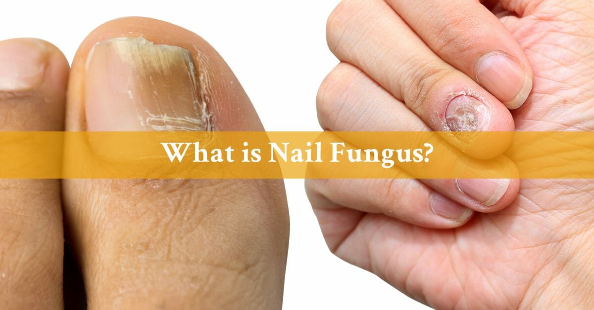 2019’s In-Depth Guide to Nail Fungus Treatment Options